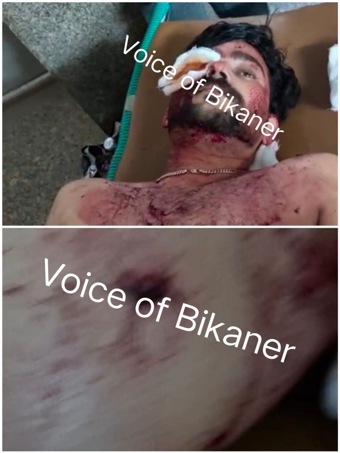 बीकानेर: युवक पर ताबड़तोड़ चाकू के वार, हालत नाजुक, इलाके में फैली दहशत