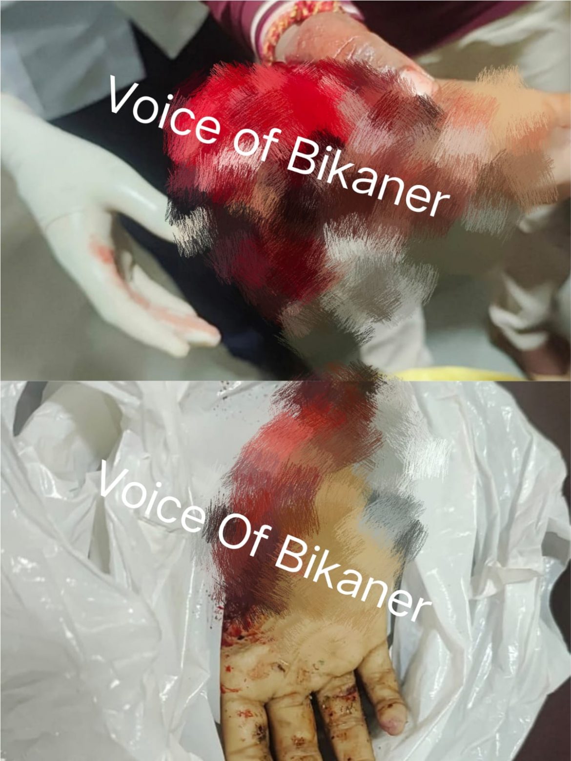 बीकानेर: डॉक्टर्स की सूझबूझ 400 किमी की दौड़, 10 घंटे का ऑपरेशन,बच्ची का कटा हाथ फिर से जोड़ा गया
