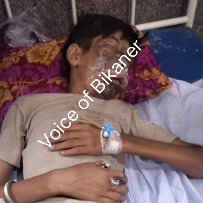बीकानेर: चार्जिंग पर रखा मोबाइल फटा, दो भाइयों की जान पर बनी
