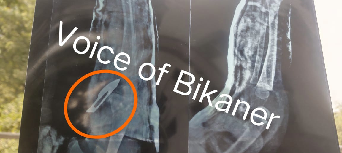बीकानेर: इलाज के नाम पर लापरवाही सर्जिकल ब्लेड के साथ कर दिया प्लास्टर, मासूम के पैर में हुए कई घाव