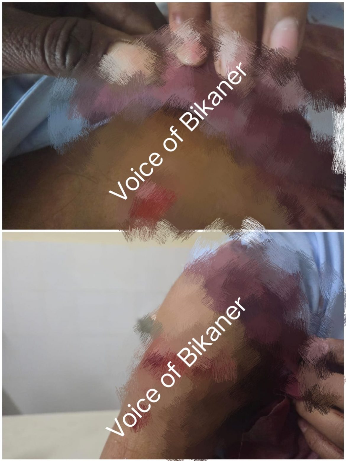 बीकानेर: मामूली कहासुनी के बाद छात्रा ने सीनियर पर किया चाकू से जानलेवा हमला