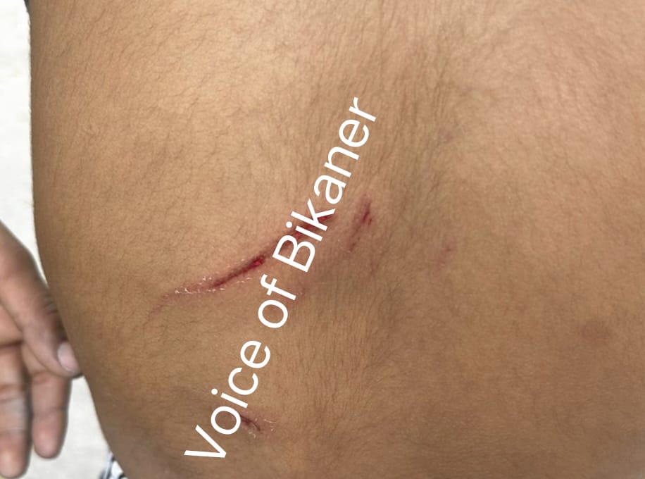 बीकानेर :आवारा कुत्तों का आतंक, 10 वर्षीय बालक पर कुत्तों का हमला,बुरी तरह नोंचा