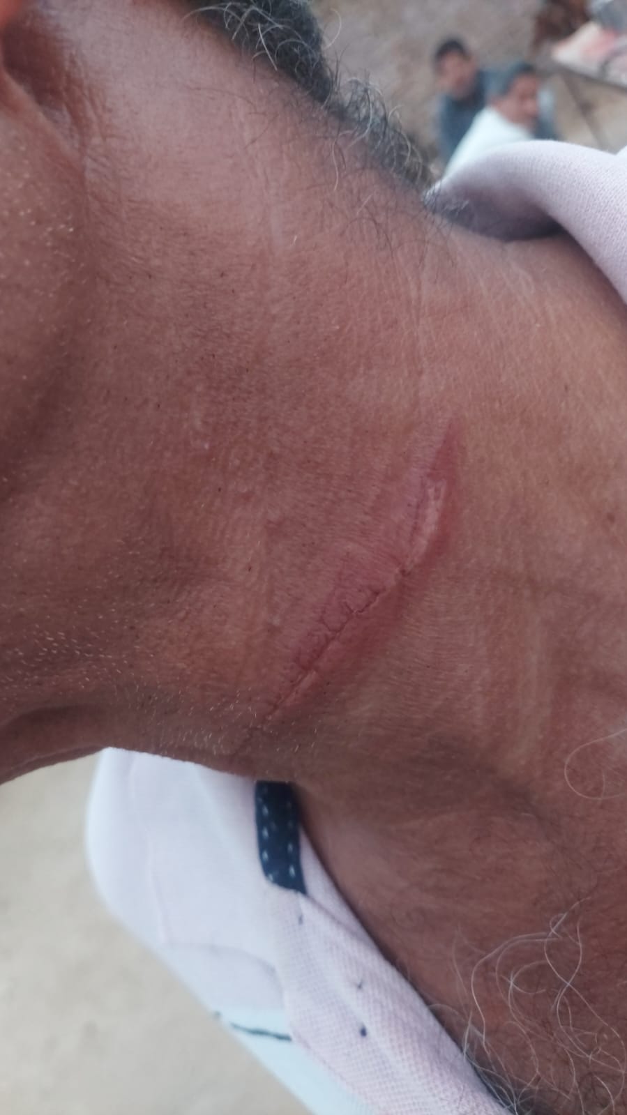 बीकानेर: चाइनीज मांझे का कहर, स्कूटी सवार की गर्दन कटी, हेलमेट ने बचाई जान