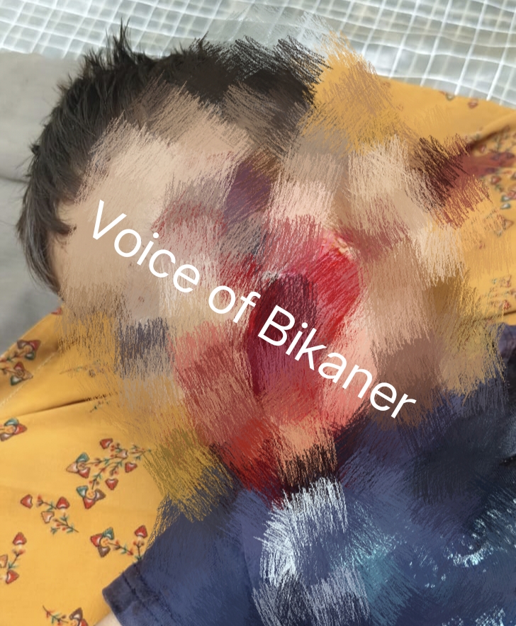 बीकानेर: आवारा कुत्तों के झुंड ने 3 वर्षीय मासूम पर किया हमला, गंभीर घायल